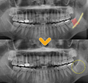 울산남구치과 사랑니 발치 전후 이미지