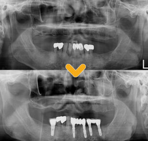 수암동치과 전후 차이