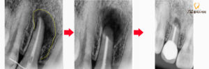 대현동치과 치료 전후
