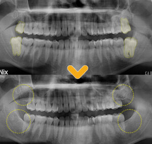 울산치과 전후 비교 이미지