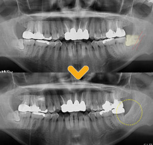 야음동치과 치료 전과 후 이미지