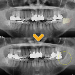 야음동치과 치료 전후