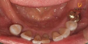 수암동치과 치료 전 이미지