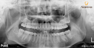 수암동치과 치료 후 사진