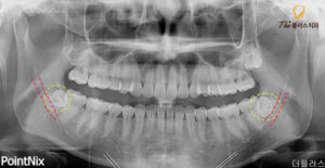 수암동치과 치료 전 파라노마