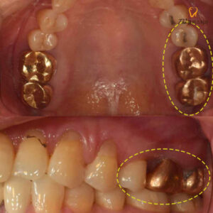 대현동치과 환자 치료전 사진