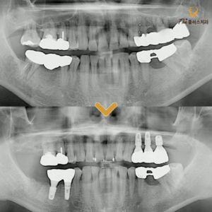 22. 울산남구치과 브릿지에 구멍이 났어요.