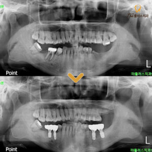 수암동치과 임란플트가 처음이라 걱정돼요.